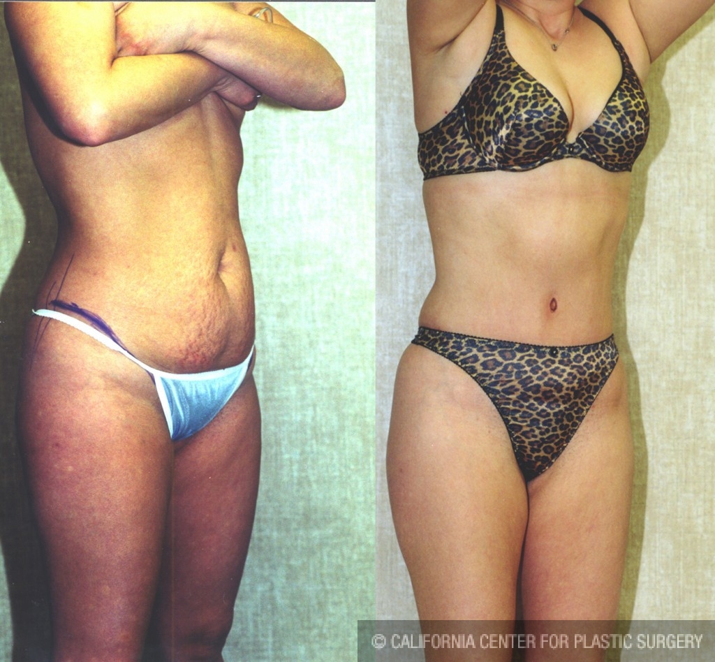 Tummy Tuck (Abdominoplasty) Small Size Before & After Patient #5750