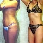 Tummy Tuck (Abdominoplasty) Small Size Before & After Patient #5750