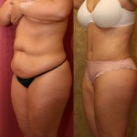 Tummy Tuck (Abdominoplasty) Medium Size Before & After Patient #5755