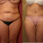 Tummy Tuck (Abdominoplasty) Medium Size Before & After Patient #5755