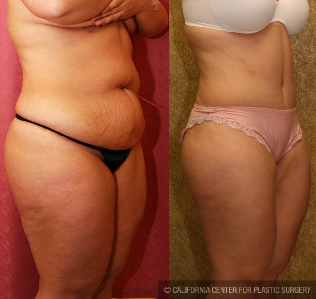 Tummy Tuck (Abdominoplasty) Medium Size Before & After Patient #5755