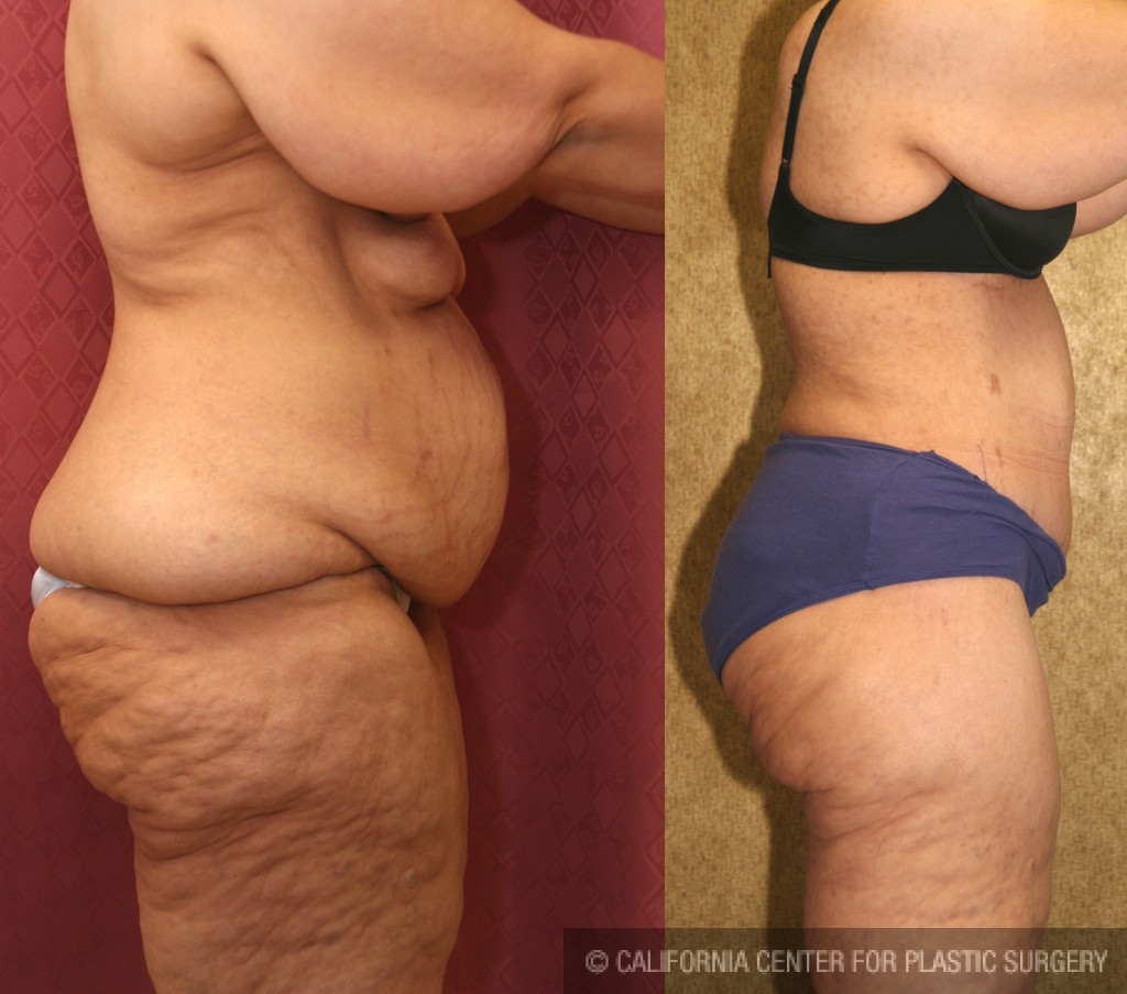 Tummy Tuck (Abdominoplasty) Plus Size Before & After Patient #5908