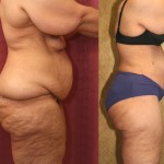 Tummy Tuck (Abdominoplasty) Plus Size Before & After Patient #5908