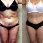 Tummy Tuck (Abdominoplasty) Medium Size Before & After Patient #5769