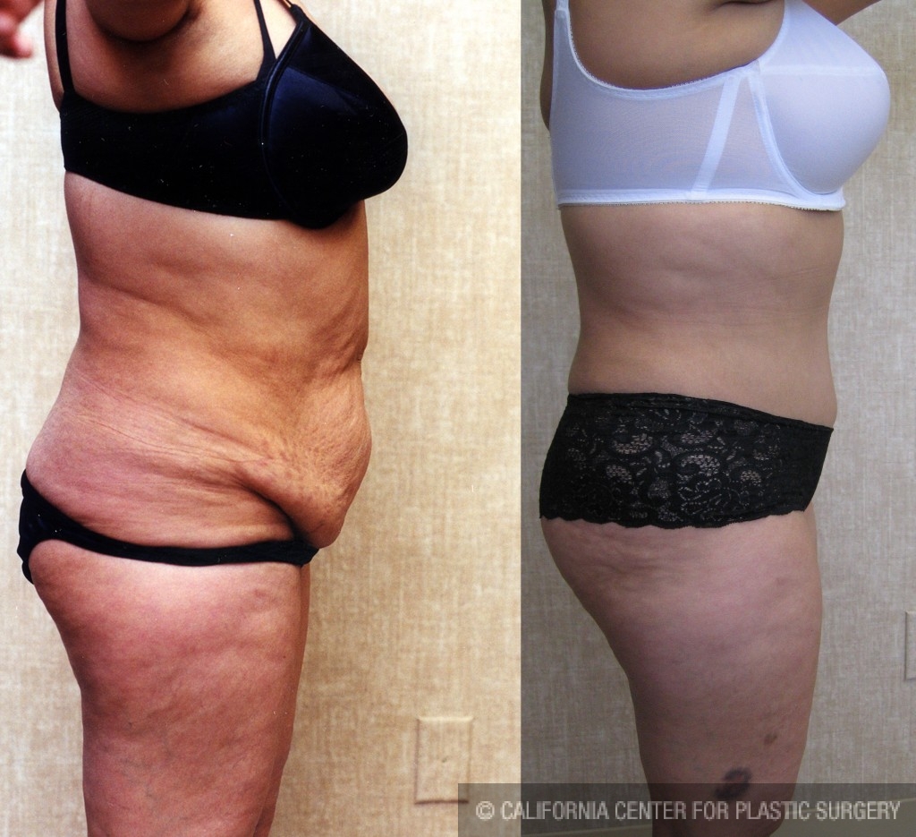 Tummy Tuck (Abdominoplasty) Medium Size Before & After Patient #5769