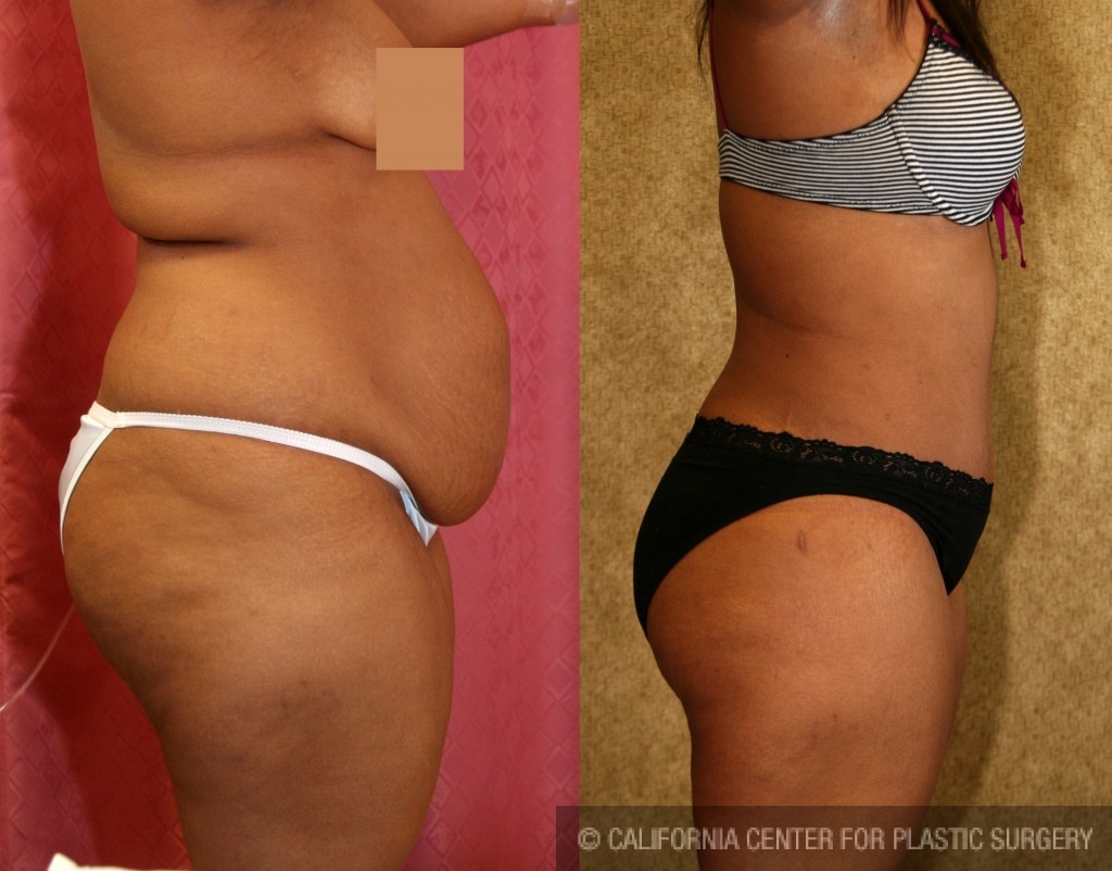 African American Tummy Tuck (Abdominoplasty) Before & After Patient #5957