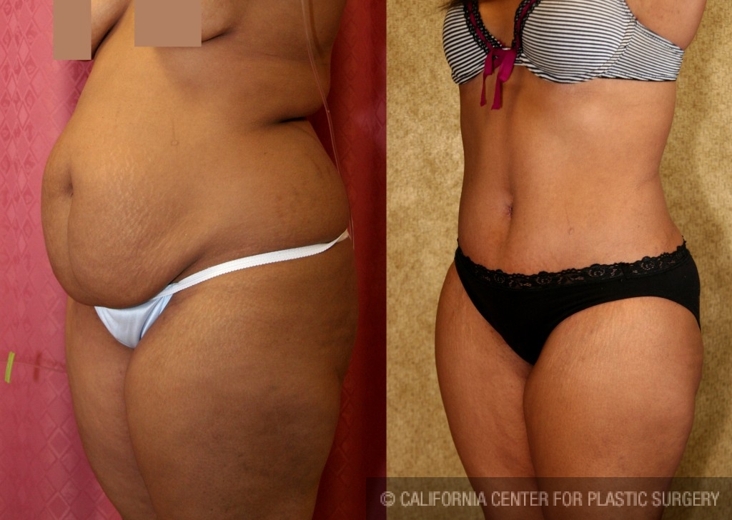 African American Tummy Tuck (Abdominoplasty) Before & After Patient #5957