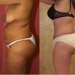 African American Tummy Tuck (Abdominoplasty) Before & After Patient #5963