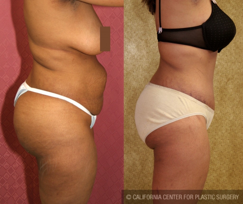 African American Tummy Tuck (Abdominoplasty) Before & After Patient #5963