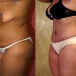 African American Tummy Tuck (Abdominoplasty) Before & After Patient #5963