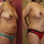 Tummy Tuck (Abdominoplasty) Medium Size Before & After Patient #5825