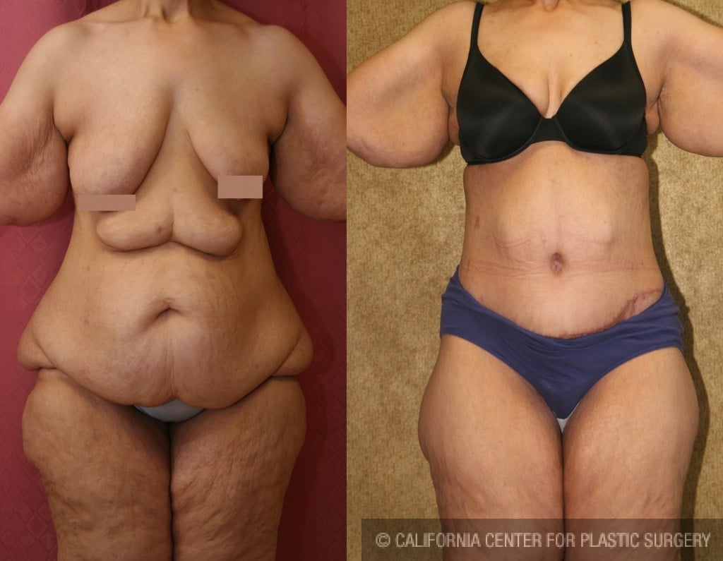 Patient #5908 Tummy Tuck (Abdominoplasty) Plus Size Before and After Photos  Encino - Plastic Surgery Gallery Glendale - Dr. Sean Younai