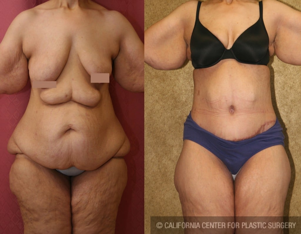 Tummy Tuck (Abdominoplasty) Plus Size Before & After Patient #5908