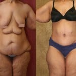 Tummy Tuck (Abdominoplasty) Plus Size Before & After Patient #5908