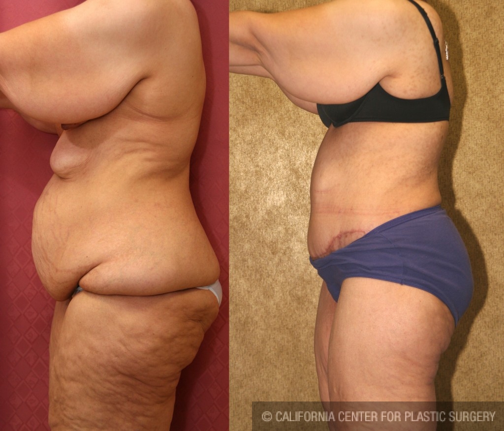Tummy Tuck (Abdominoplasty) Plus Size Before & After Patient #5908