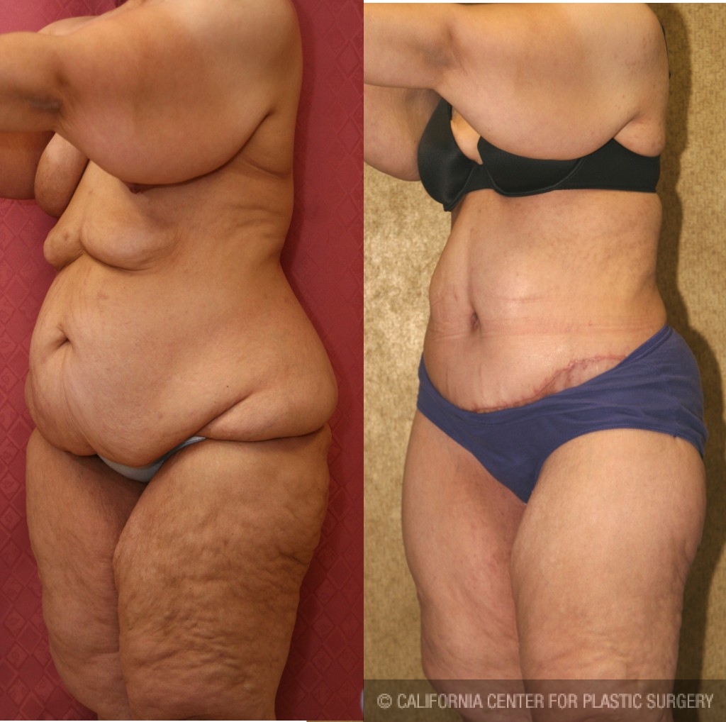 Tummy Tuck (Abdominoplasty) Plus Size Before & After Patient #5908