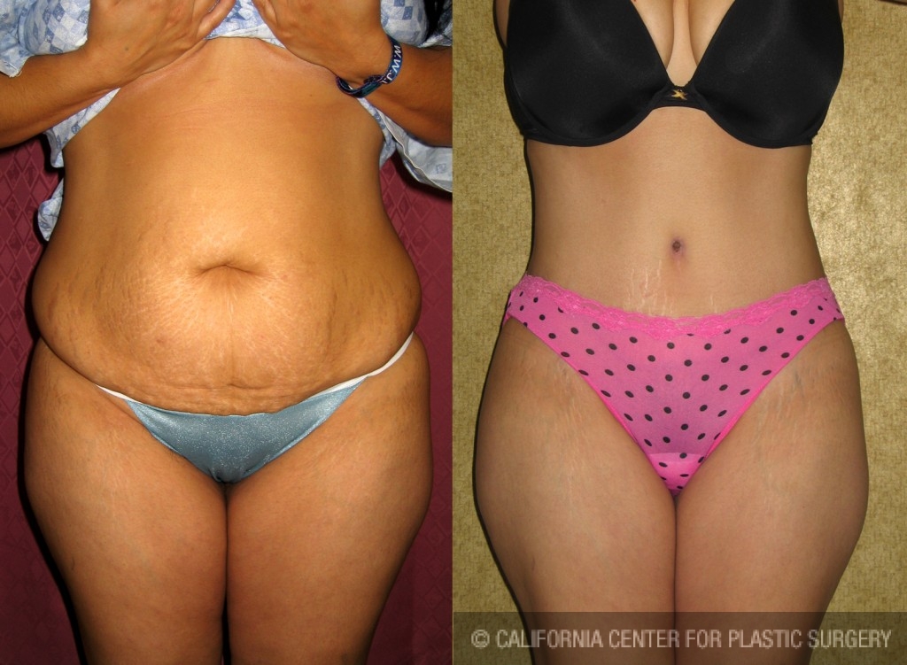 Tummy Tuck (Abdominoplasty) Medium Size Before & After Patient #5813