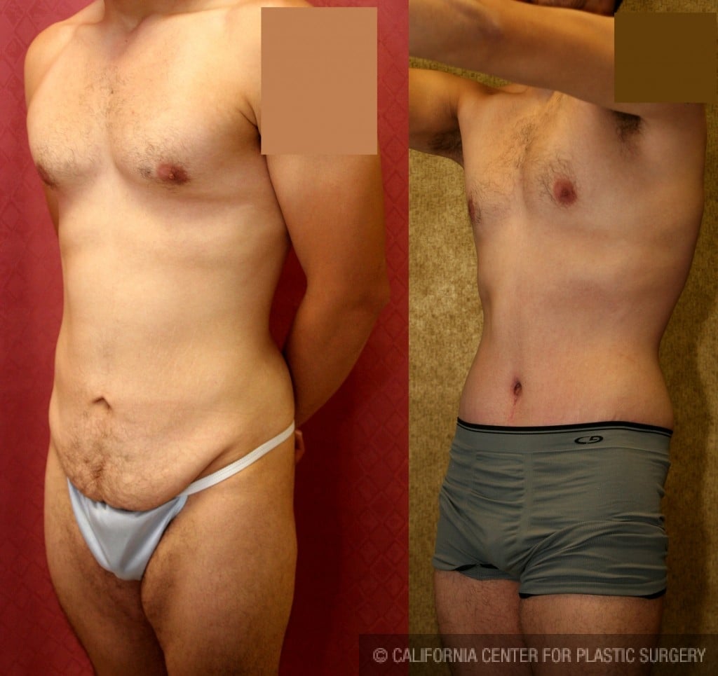 Male Tummy Tuck (abdominoplasty) Before & After Patient #6009