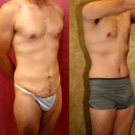 Male Tummy Tuck (abdominoplasty) Before & After Patient #6009