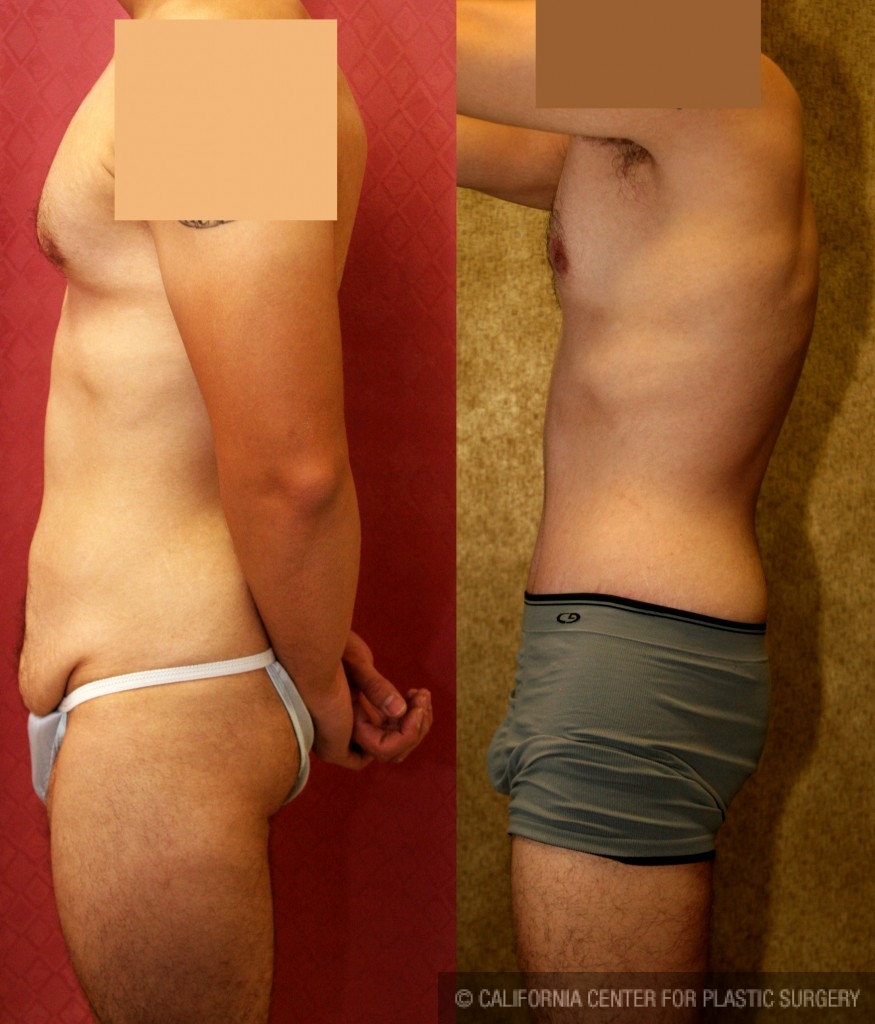 Male Tummy Tuck (abdominoplasty) Before & After Patient #6009