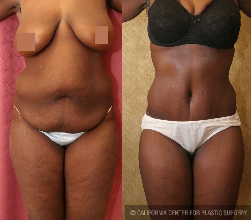 African American Tummy Tuck (Abdominoplasty) Before & After Patient #5969