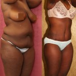 African American Tummy Tuck (Abdominoplasty) Before & After Patient #5969