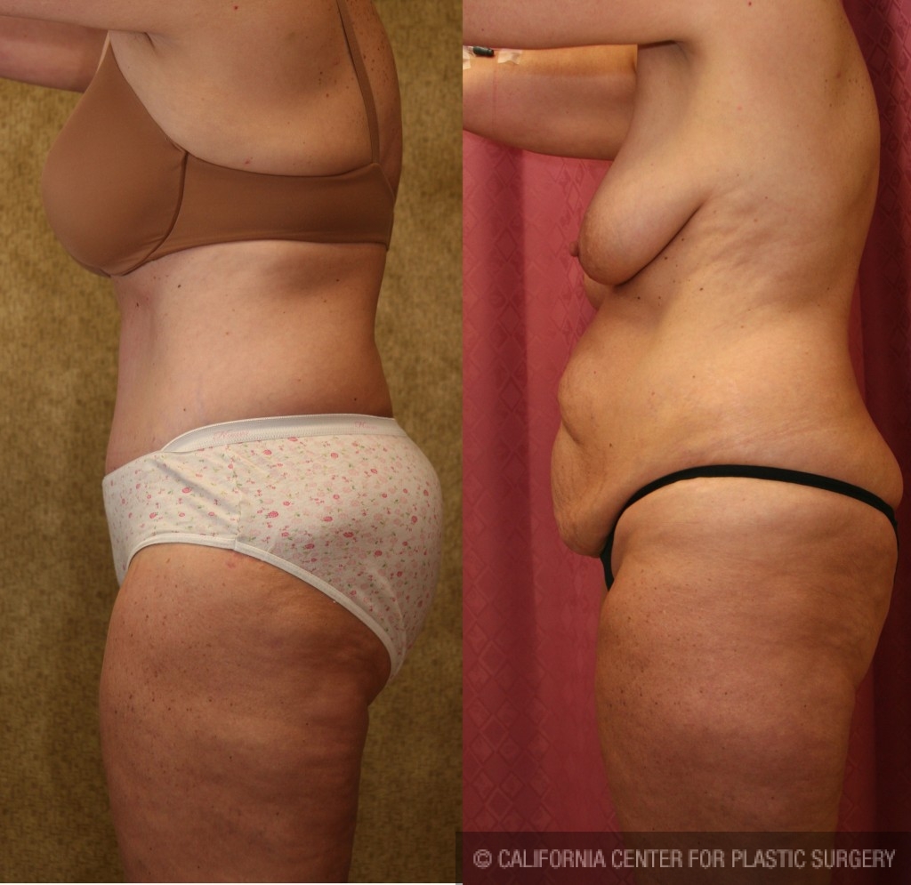 Tummy Tuck (Abdominoplasty) Medium Size Before & After Patient #5821