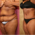 Tummy Tuck (Abdominoplasty) Plus Size Before & After Patient #5884