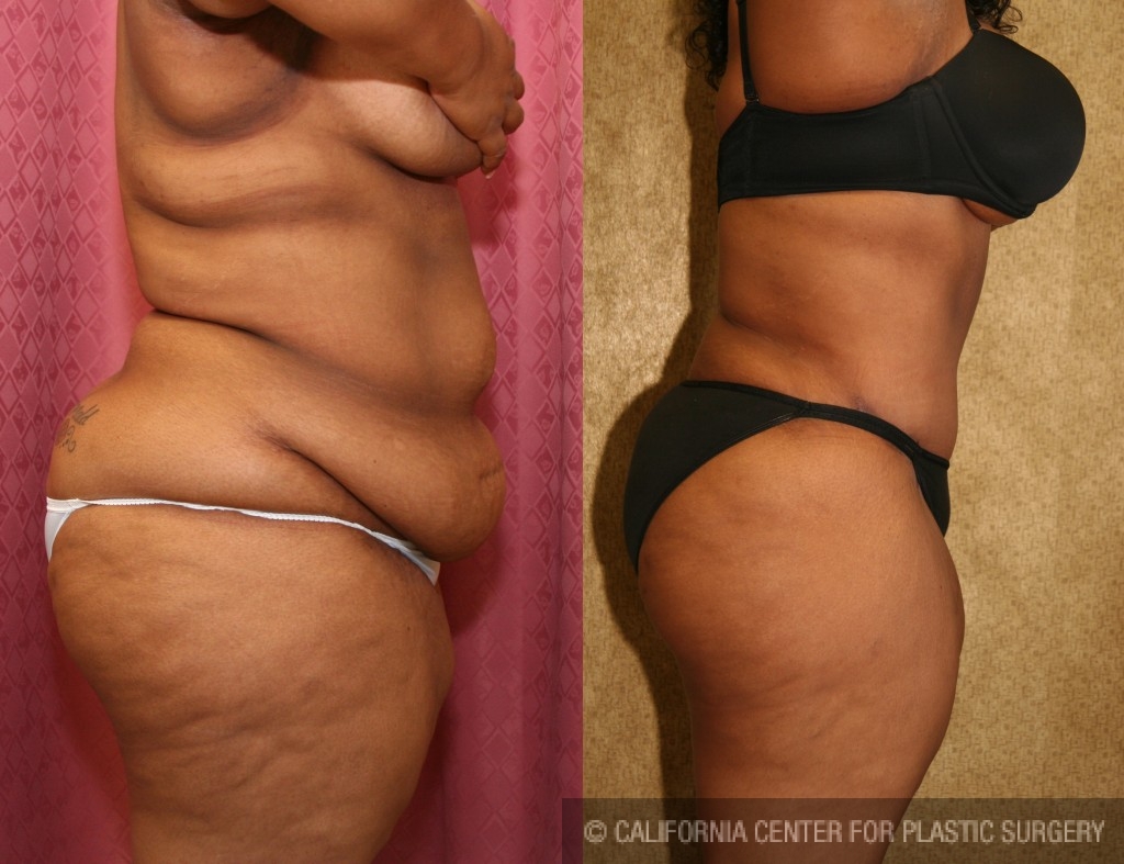Tummy Tuck (Abdominoplasty) Plus Size Before & After Patient #5884