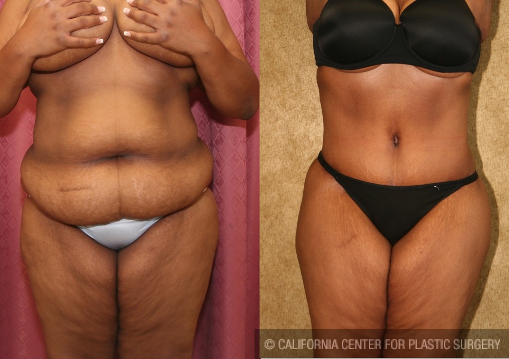 African American Tummy Tuck (Abdominoplasty) Before & After Patient #5940