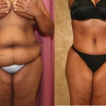 African American Tummy Tuck (Abdominoplasty) Before & After Patient #5940