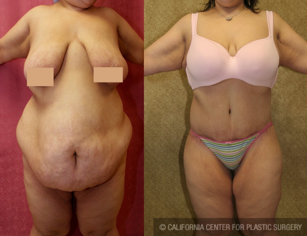 Tummy Tuck (Abdominoplasty) Plus Size Before & After Patient #5874