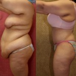 Tummy Tuck (Abdominoplasty) Plus Size Before & After Patient #5874