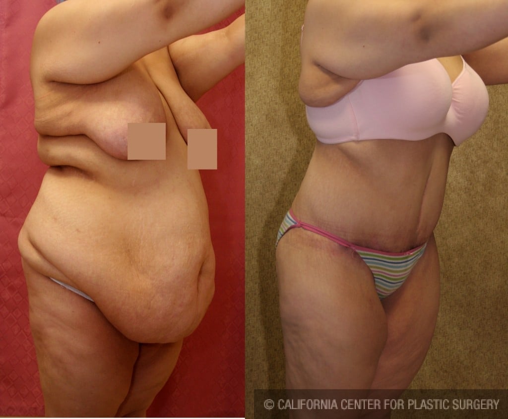 Tummy Tuck (Abdominoplasty) Plus Size Before & After Patient #5874