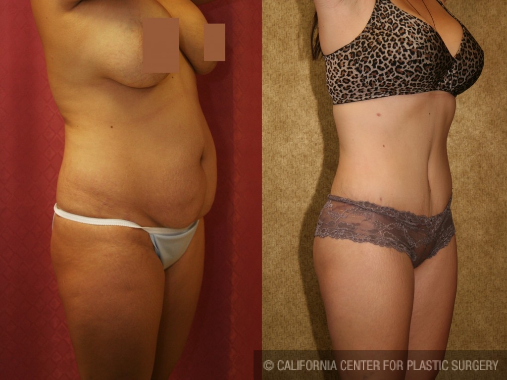 Tummy Tuck (Abdominoplasty) Small Size Before & After Patient #5726