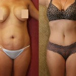 Tummy Tuck (Abdominoplasty) Small Size Before & After Patient #5726