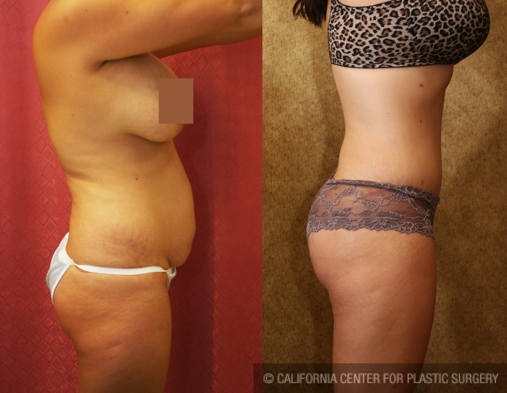 Tummy Tuck (Abdominoplasty) Small Size Before & After Patient #5726