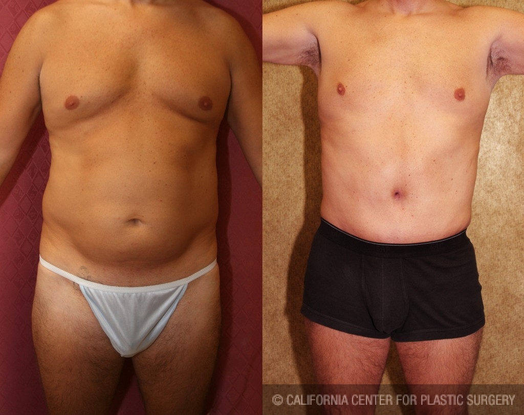 Male Tummy Tuck (abdominoplasty) Before & After Patient #6014