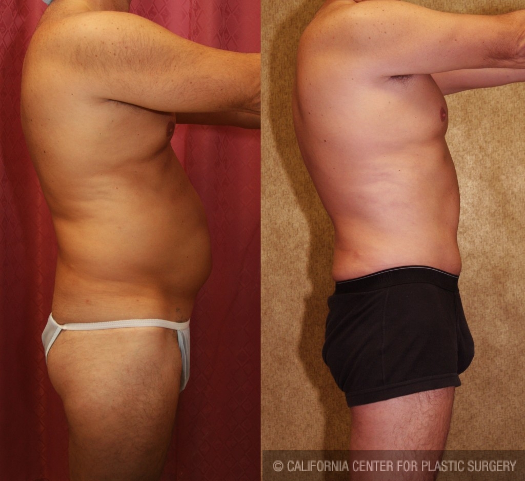 Male Tummy Tuck (abdominoplasty) Before & After Patient #6014