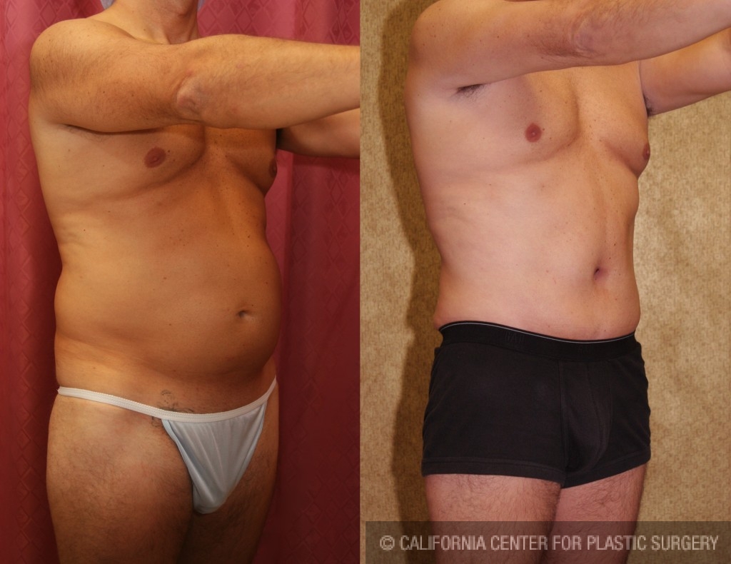 Male Tummy Tuck (abdominoplasty) Before & After Patient #6014