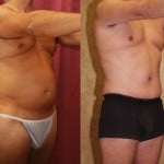 Male Tummy Tuck (abdominoplasty) Before & After Patient #6014