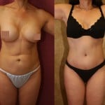 Tummy Tuck (Abdominoplasty) Medium Size Before & After Patient #5831