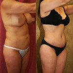 Tummy Tuck (Abdominoplasty) Medium Size Before & After Patient #5831
