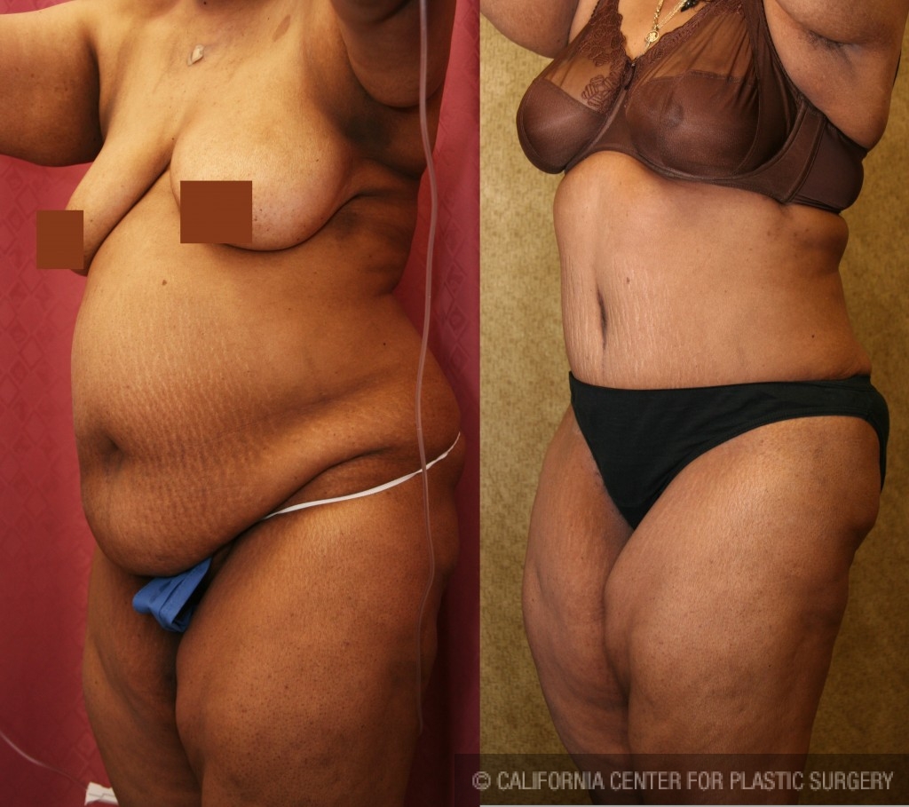 African American Tummy Tuck (Abdominoplasty) Before & After Patient #5944