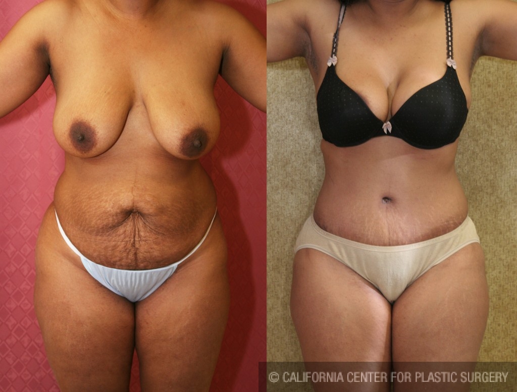 African American Tummy Tuck Before & After Patient #5949