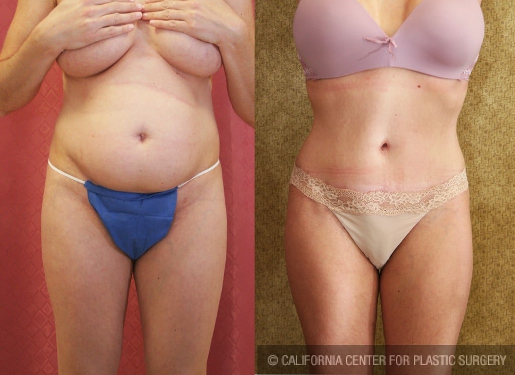Tummy Tuck (Abdominoplasty) Medium Size Before & After Patient #5773
