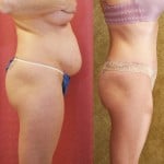 Tummy Tuck (Abdominoplasty) Medium Size Before & After Patient #5773