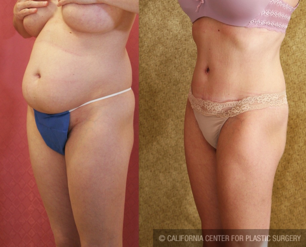 Tummy Tuck (Abdominoplasty) Medium Size Before & After Patient #5773