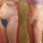 Tummy Tuck (Abdominoplasty) Medium Size Before & After Patient #5773