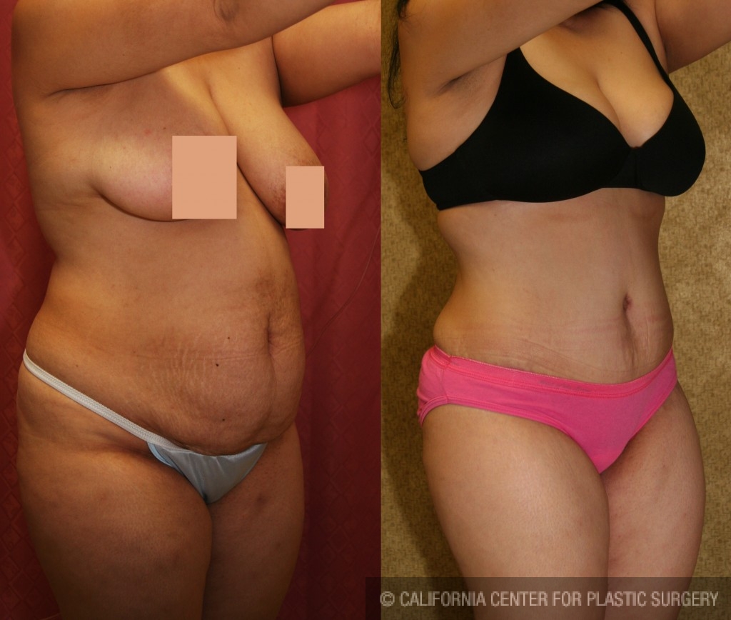 Tummy Tuck (Abdominoplasty) Medium Size Before & After Patient #5777